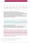 dysrhythmia questions and answers 2023 