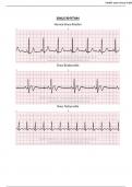 EKG strips SINUS RHYTHM