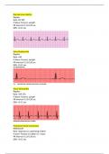 Relias Dysrhythmia Basic A Exam Guide set, Revised & Verified 100%