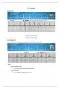 ECG Rhythms 2 Complete Question And Answers With Latest Updates