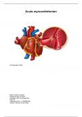 Gezondheidsbevordering Acute myocardinfarcten