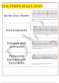 ECG STRIPS NCLEX 2023