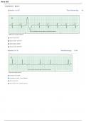 Grand Canyon University NUR635/ NUR 635 Dysrhythmia – Basic A Questions With Complete Solutions