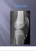 - Osgood Schlatter Disease