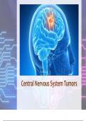 Central Nervous System Tumors