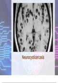 Neurocysticercosis with complete solution