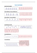 ECG Afwijkingen