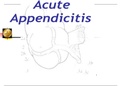 Acute Appendicitis ANATOMY AN 310