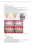 Samenvatting  Mondzorgkunde Parodontologie (MZK-PAROD) HAN Bachelor 1/ Propedeuse Collegejaar 2021-2022: Thema 5: Van gingivitis naar parodontitis