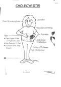 CHOLECYSTITIS