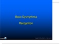 Basic Dysrhythmia Recognition 2023